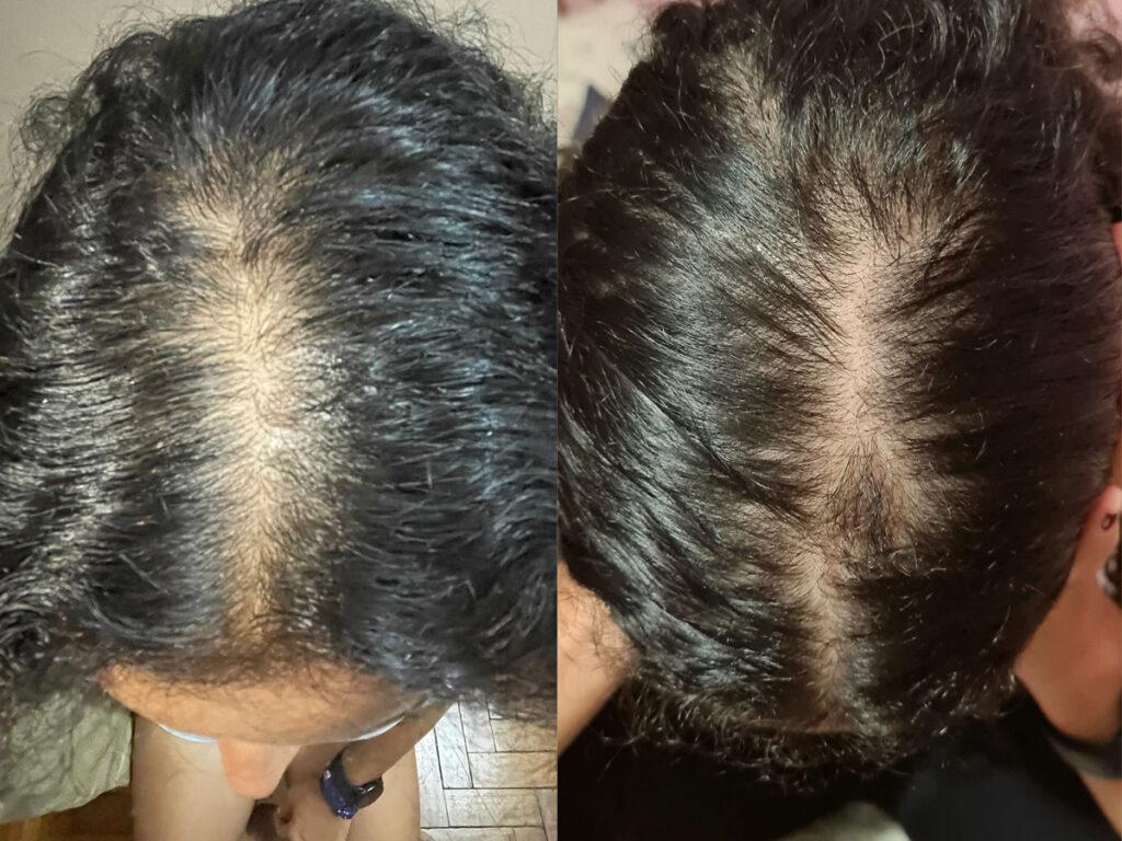 Stopping androgenic alopecia in women. Before and after hair growth picture of Marilia.