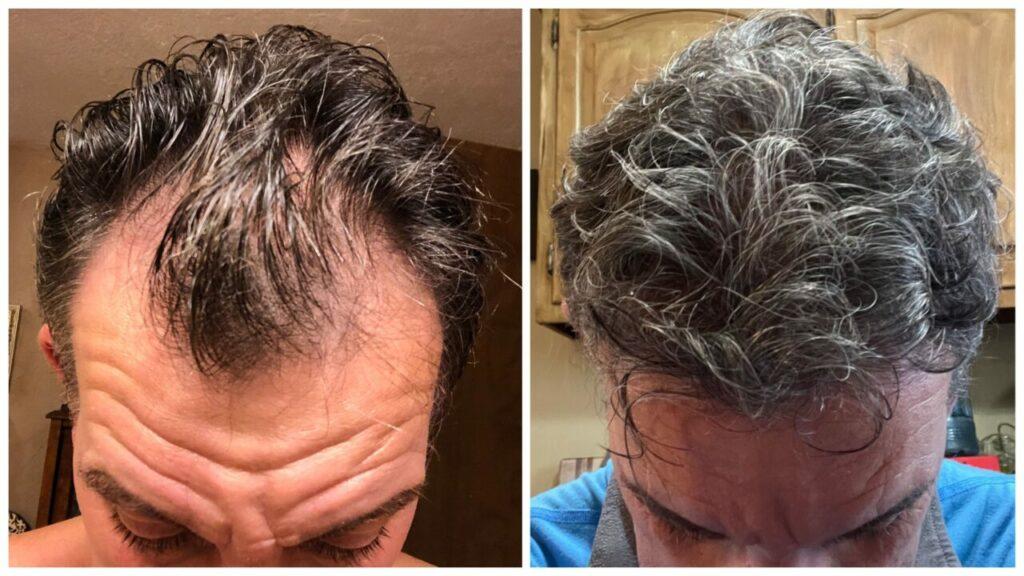 NewHairFormula client Casey Shawver's testimonial before and after pictures documenting his amazing hair regrowth!