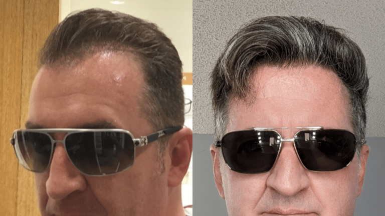 Before and After 4 Year on NewHairFormula