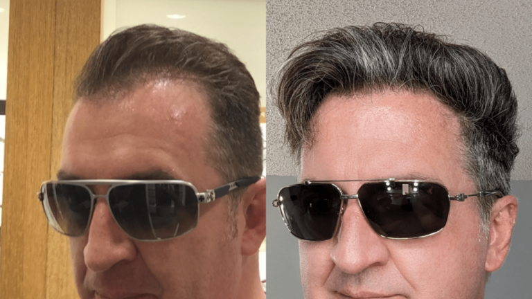 Before and After 4 Year on NewHairFormula (side view)